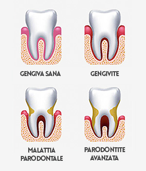 Stadi della parodontite