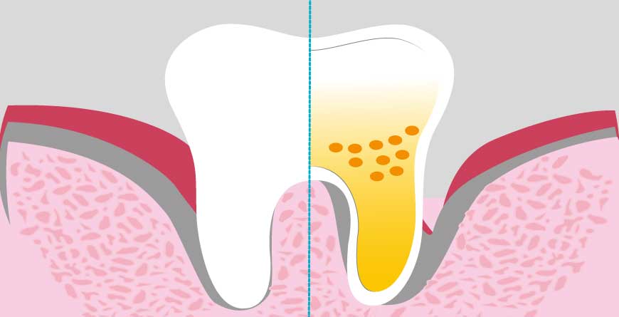 trattamenti-parodontali-evitano-perdita-denti