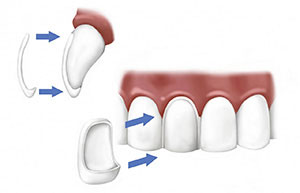 Applicazione delle faccette dentali 