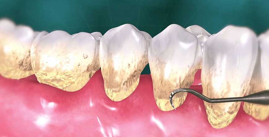 Rimuovere il tartaro può indebolire i denti? - Studio Dentistico  Michelangelo 13