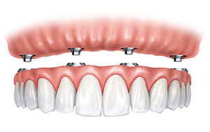 Aggancio protesi overdenture