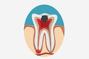 Carie e infiammazione della polpa