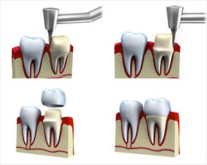 Fasi dell’incapsulamento dentale