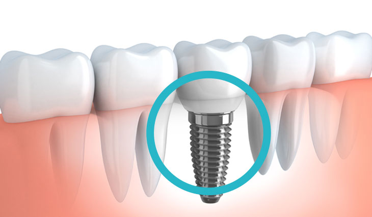 Impianti dentali al Vomero