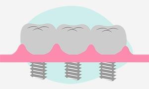 Implantologia in protesi fissa di uno o piu denti