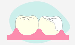 Intarsio dentale composito