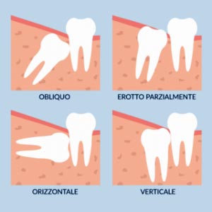 Tipologie di disontodiasi, mal-posizionamento del dente del giudizio.