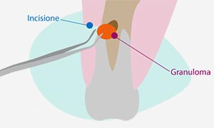 L’apicectomia consente di rimuovere il granuloma e sigillare l’apice del dente con una piccola incisione sulla gengiva.