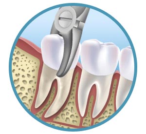 L'estrazione (o avulsione) dentale