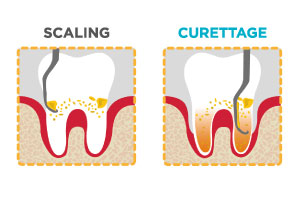 Dentista Vomero parodontite scaling curettage