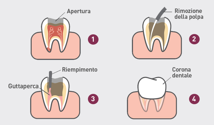 devitalizzazione-dente-vomero-napoli