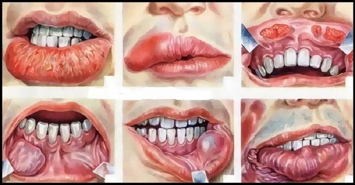 Le cause del Cancro orale o tumore alla bocca
