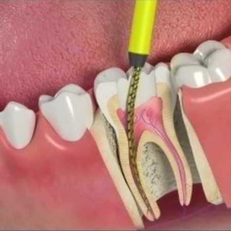 devitalizzazione-dente-