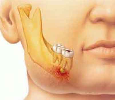 trattamento-granuloma-dentale-