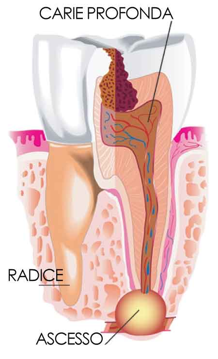 trattamento-granuloma-dentale-ascesso