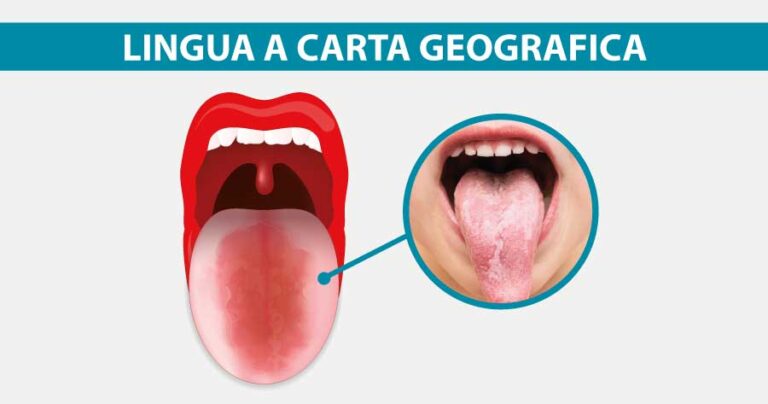 lingua-a-carta-geografica-cause-e-cura