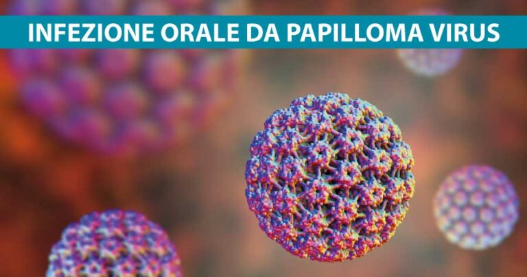 infezione-orale-da-papilloma-virus-dentista-vomero-napoli