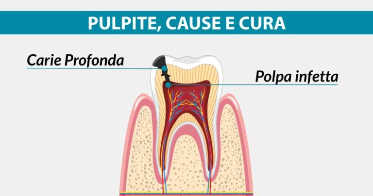 pulpite-cause-e-cura-michelangelo-13-dentista-vomero-napoli