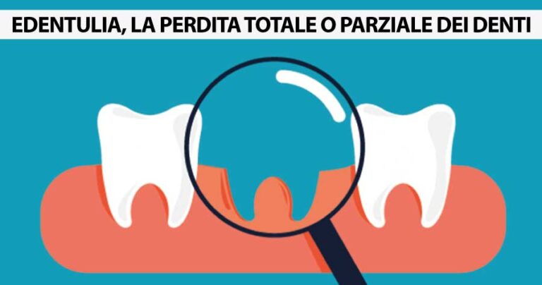 edentulia-perdita-totale-parziale-denti-michelangelo13