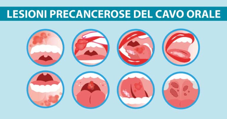 lesioni-precancerose-del-cavo-orale-dentista-vomero-michelangelo-13
