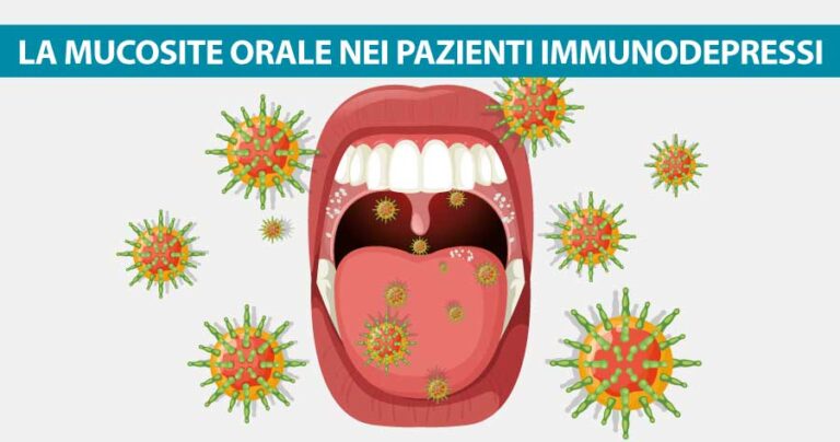 mucosite-orale-pazienti-immunodepressi-dentista-vomero