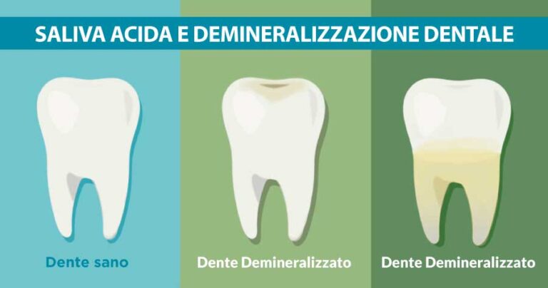 saliva-acida-e-demineralizzazione-dentista-vomero