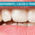 Denti trasparenti, cause e trattamenti