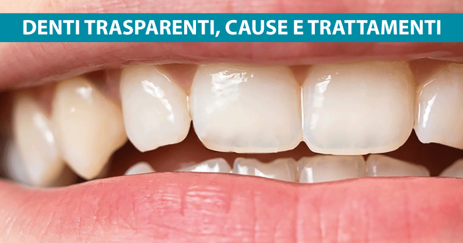denti-trasparenti-cause-e-trattamenti-michelangelo13