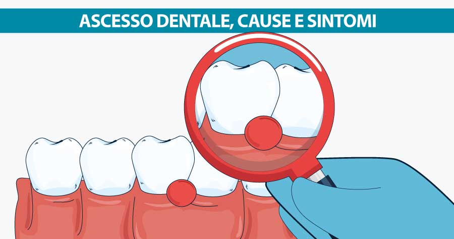ascesso-dentale-cause-e-sintomi-michelangelo13
