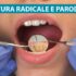 Levigatura radicolare e parodontite