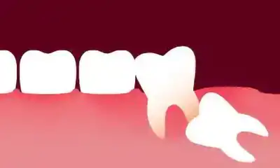 molare del giudizio incluso michelangelo 13 dentista vomero