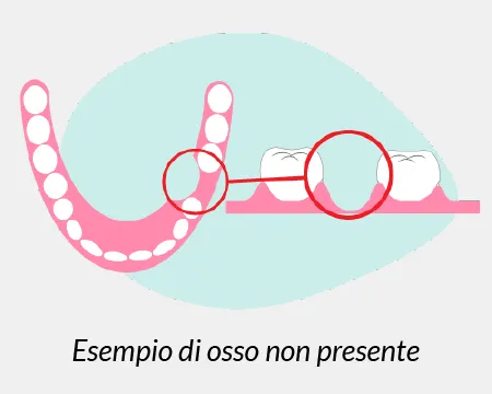 esempio di osso non presente